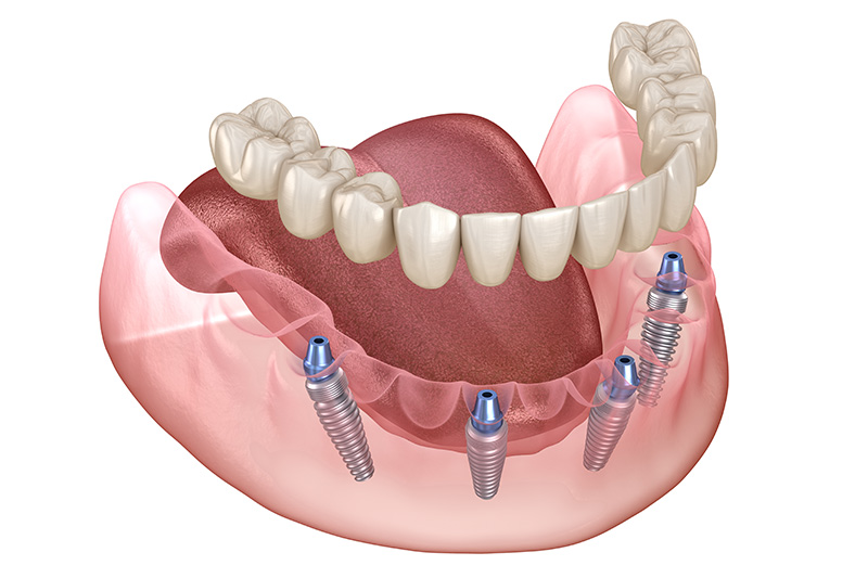 Root Canal in Pearland