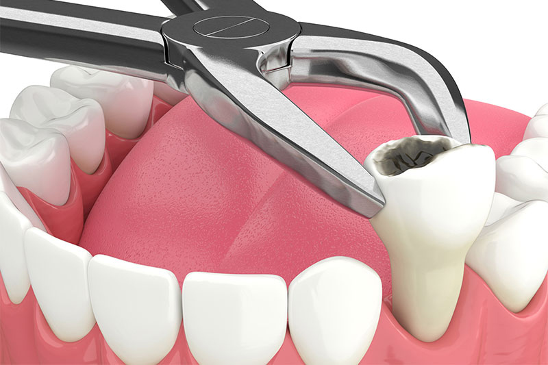 Root Canal in Pearland