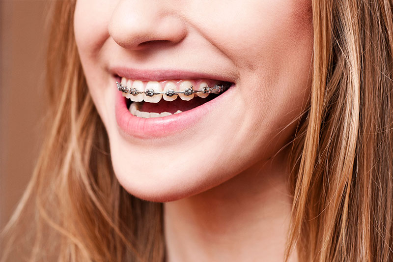 Orthodontics in Pearland