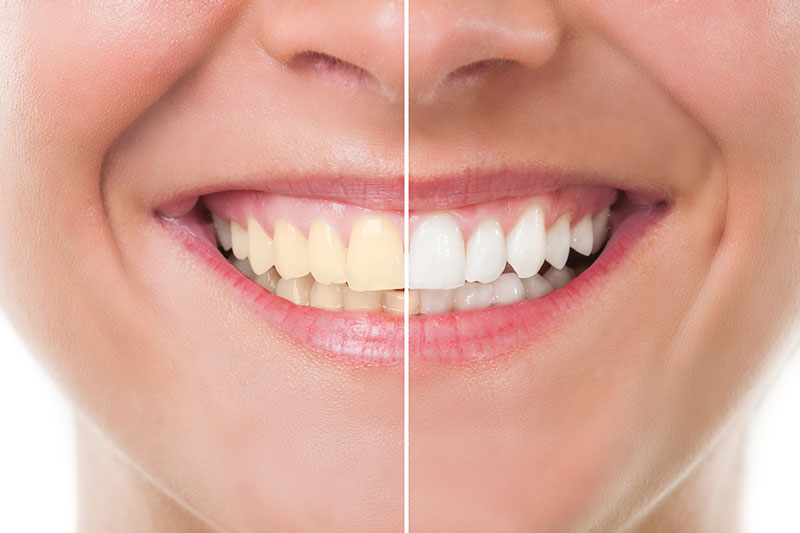 Teeth Whitening in Pearland